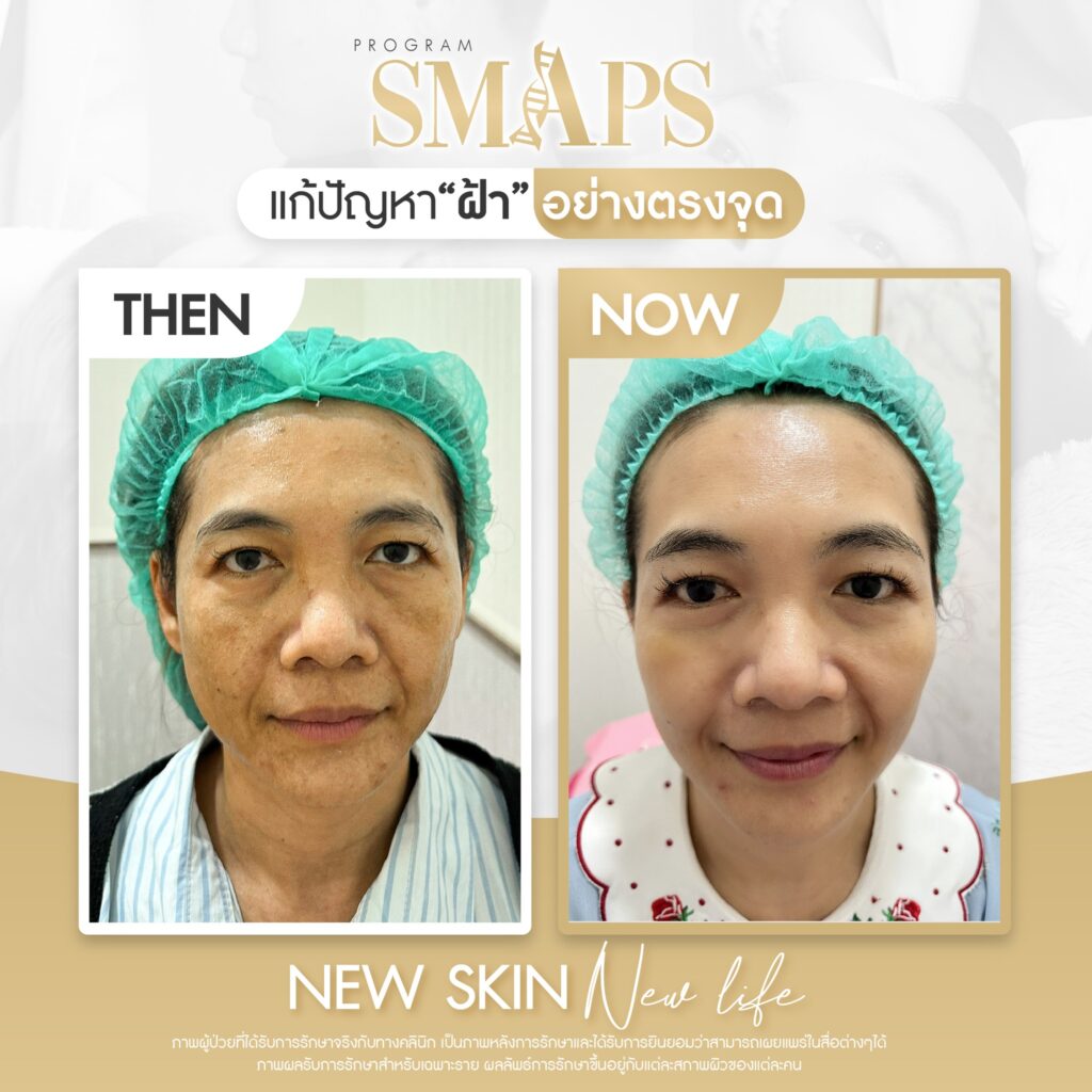 before after รักษาฝ้า