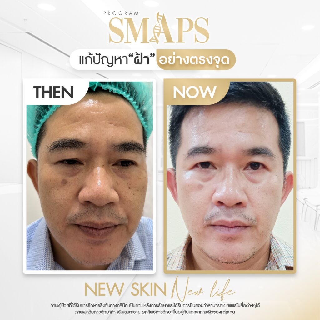 before after รักษาฝ้า 3