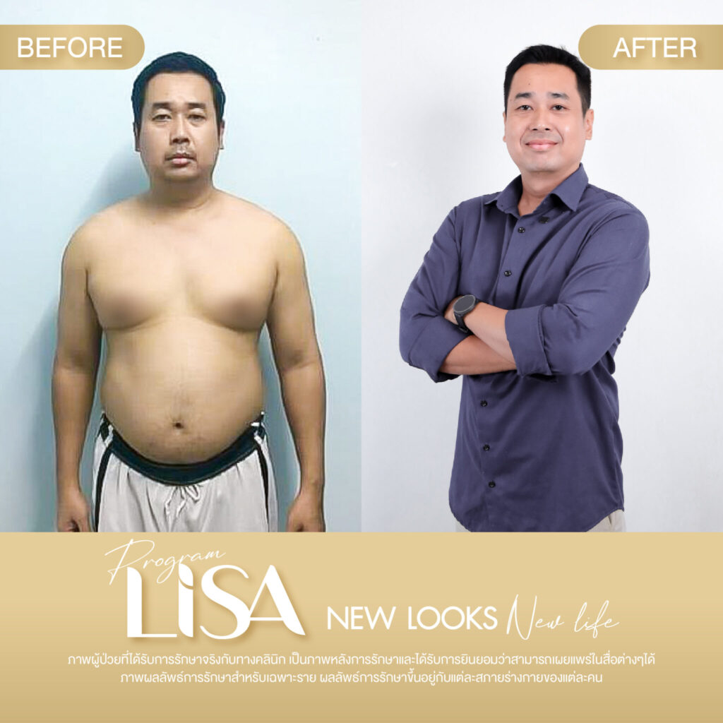 ผลการรักษา โปรแกรมลดน้ำหนัก Lisa -1