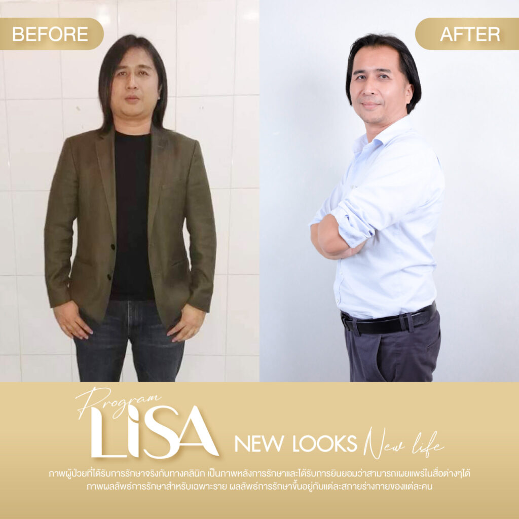ผลการรักษา โปรแกรมลดน้ำหนัก Lisa -2