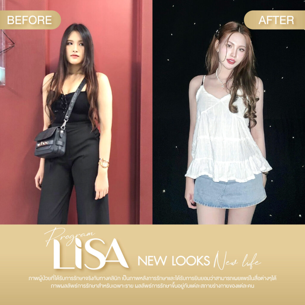 ผลการรักษา โปรแกรมลดน้ำหนัก Lisa -3