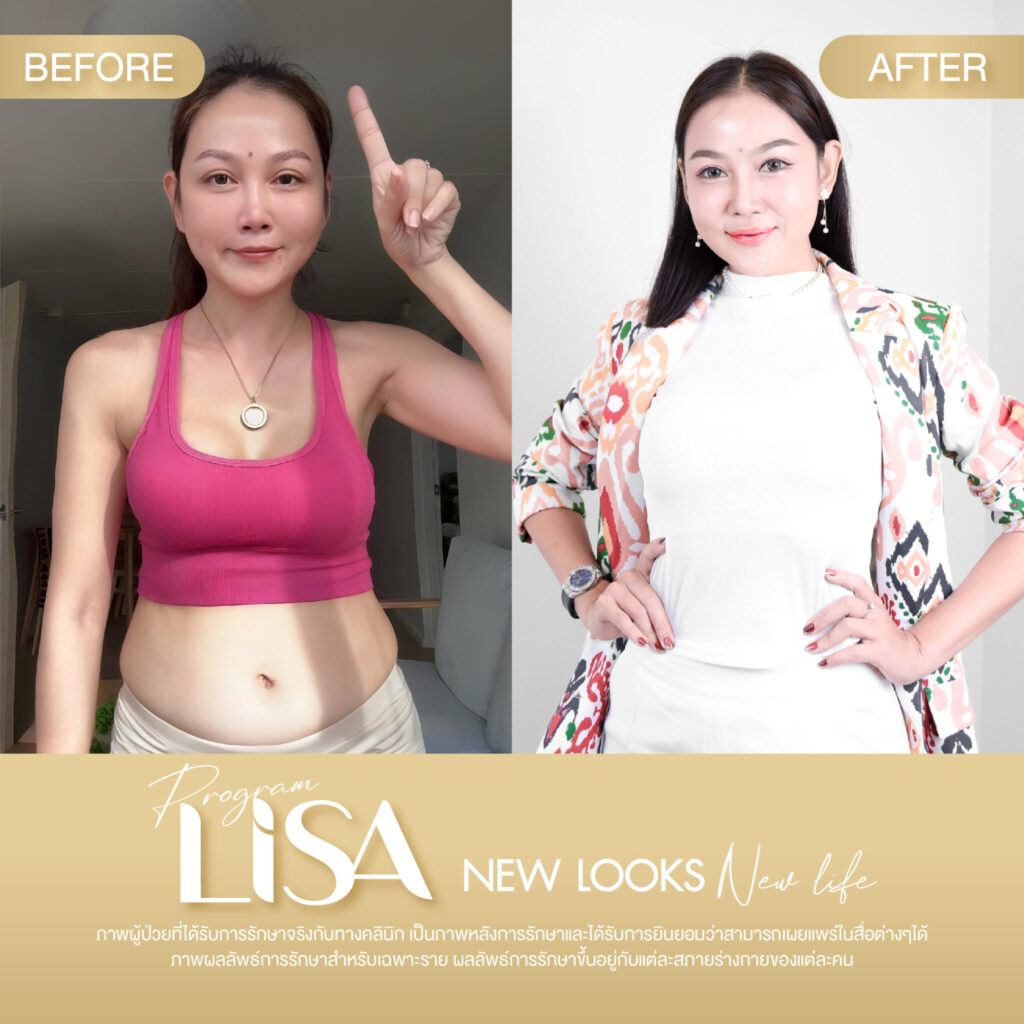 ผลการรักษา โปรแกรมลดน้ำหนัก Lisa -7
