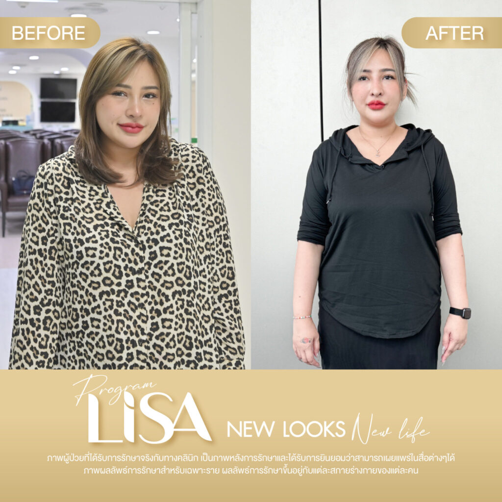 ผลการรักษา โปรแกรมลดน้ำหนัก Lisa -9