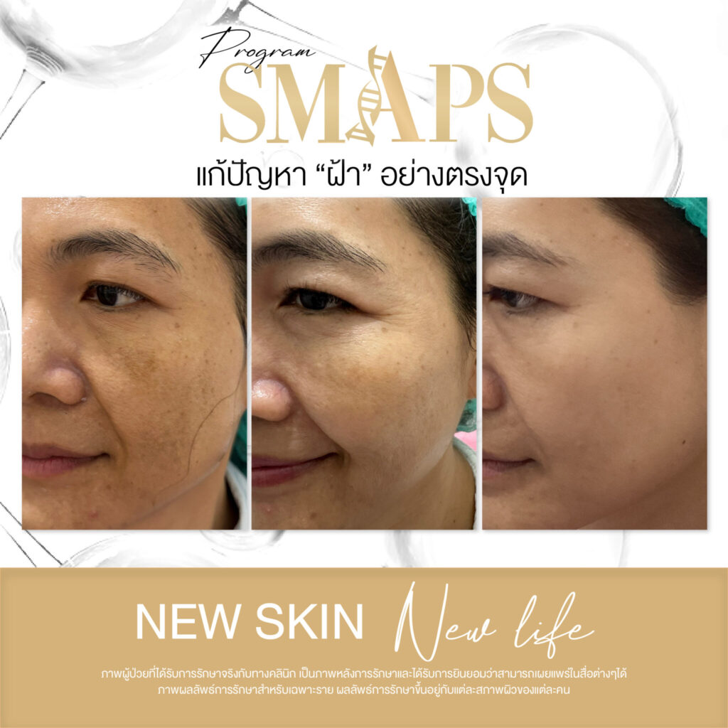 แก้ปัญหา ฝ้า อย่างตรงจุด 11