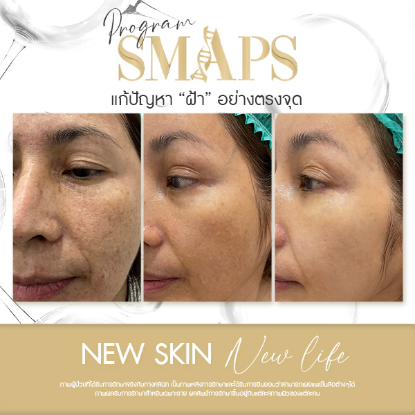 แก้ปัญหา ฝ้า อย่างตรงจุด 13