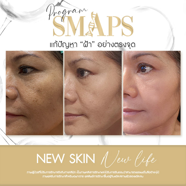 แก้ปัญหา ฝ้า อย่างตรงจุด 16