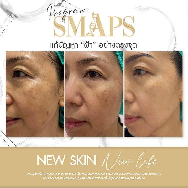 แก้ปัญหา ฝ้า อย่างตรงจุด 18