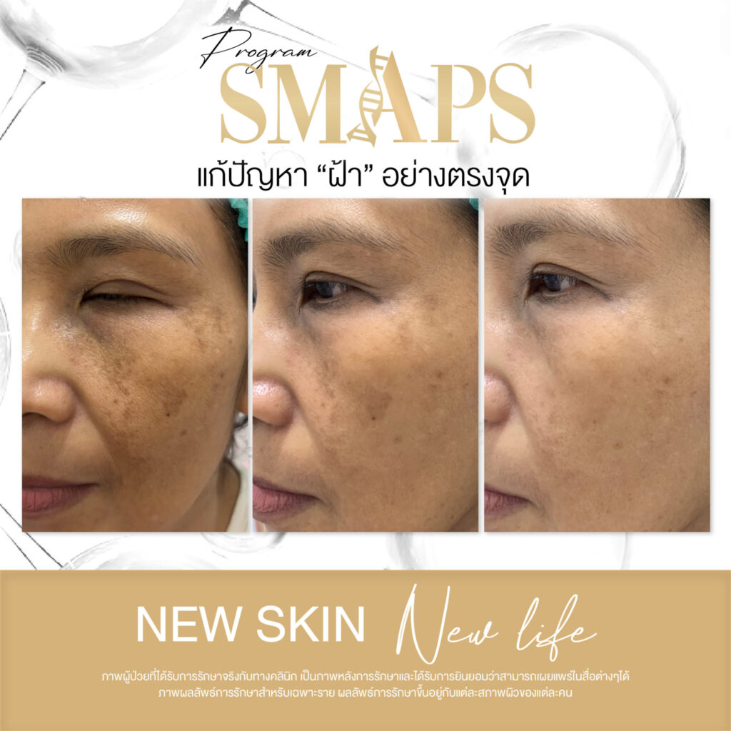 แก้ปัญหา ฝ้า อย่างตรงจุด 20