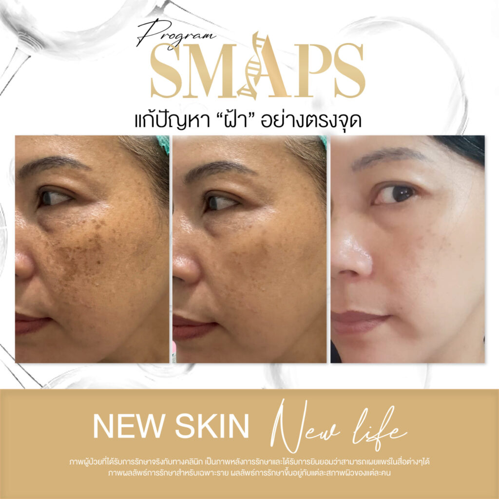 แก้ปัญหา ฝ้า อย่างตรงจุด 21