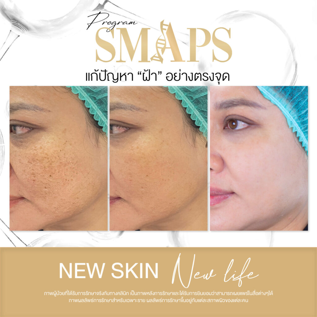 แก้ปัญหา ฝ้า อย่างตรงจุด 4