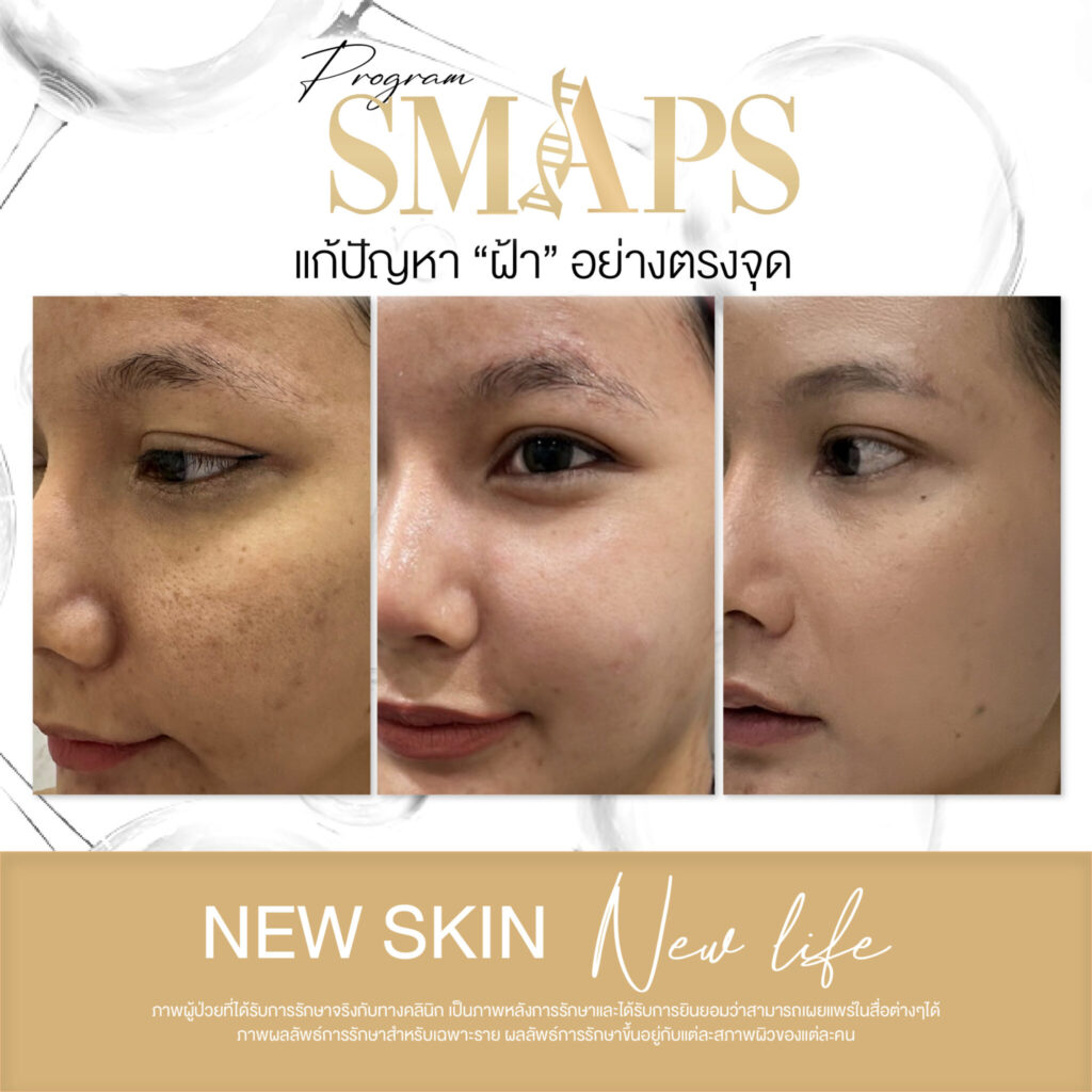 แก้ปัญหา ฝ้า อย่างตรงจุด 5