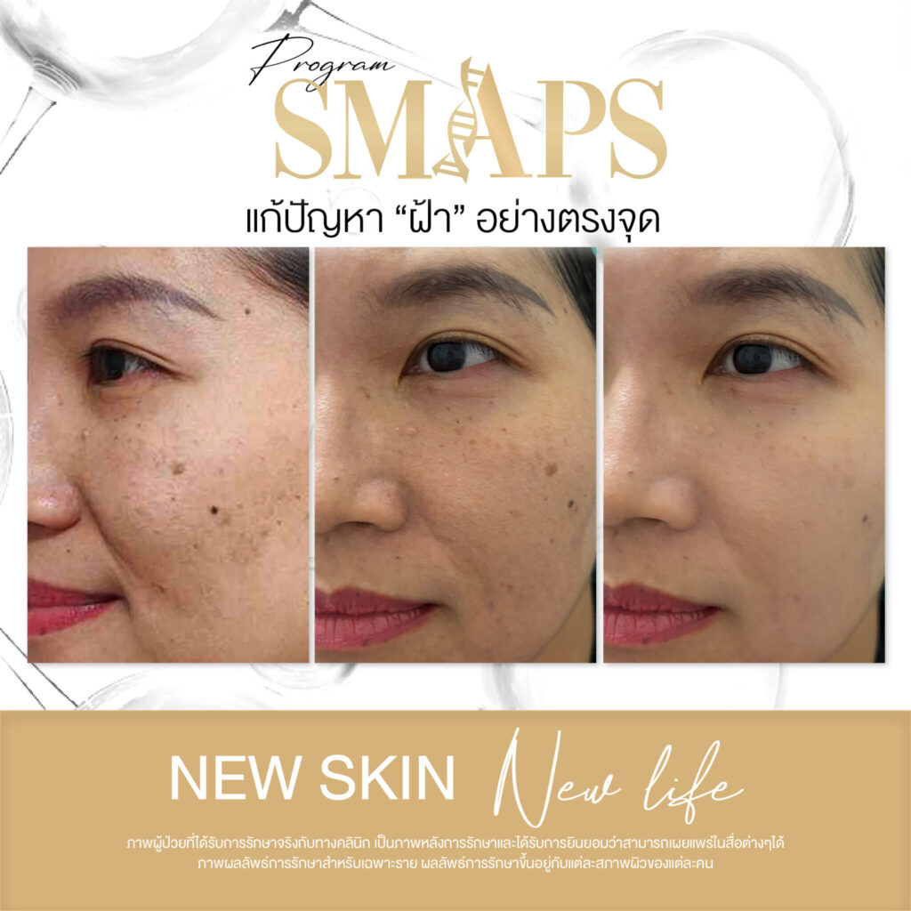 แก้ปัญหา ฝ้า อย่างตรงจุด 7