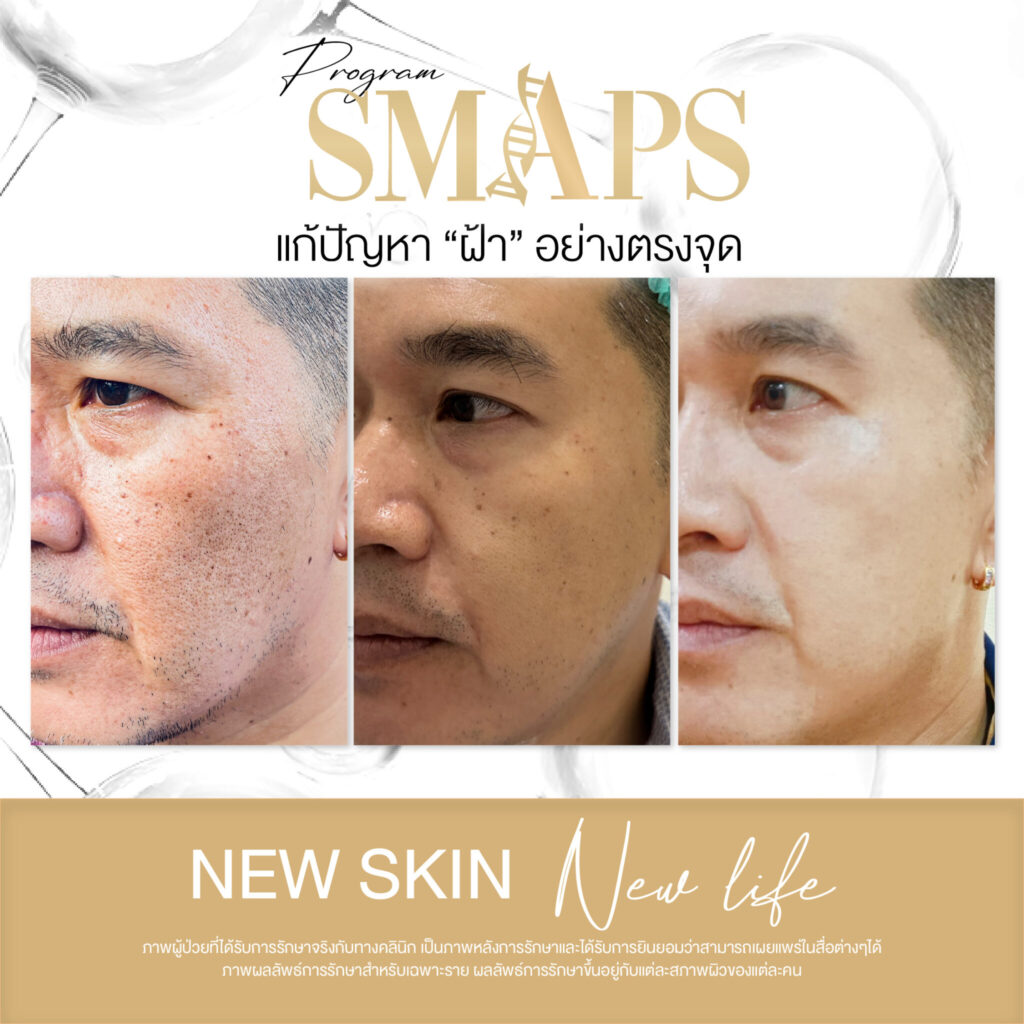 แก้ปัญหา ฝ้า อย่างตรงจุด 8