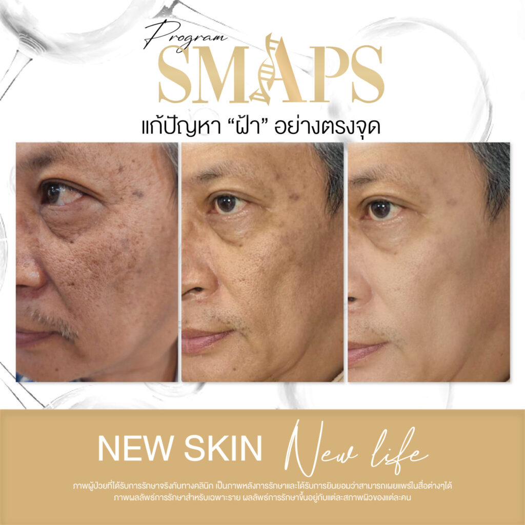 แก้ปัญหา ฝ้า อย่างตรงจุด 9