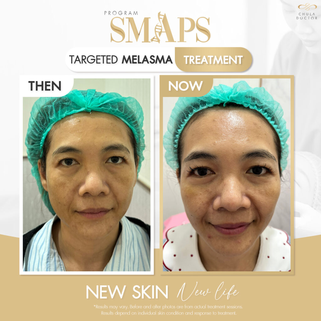 before after รักษาฝ้า