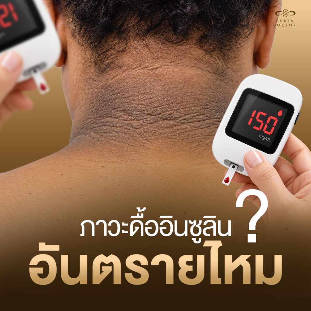 ภาวะดื้ออินซูลิน อันตรายไหม